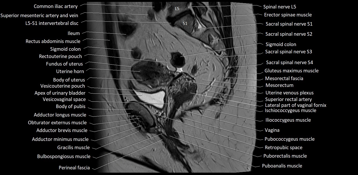 Sagittal cross sectional anatomy of female pelvis (MRI 3T) image 17.webp